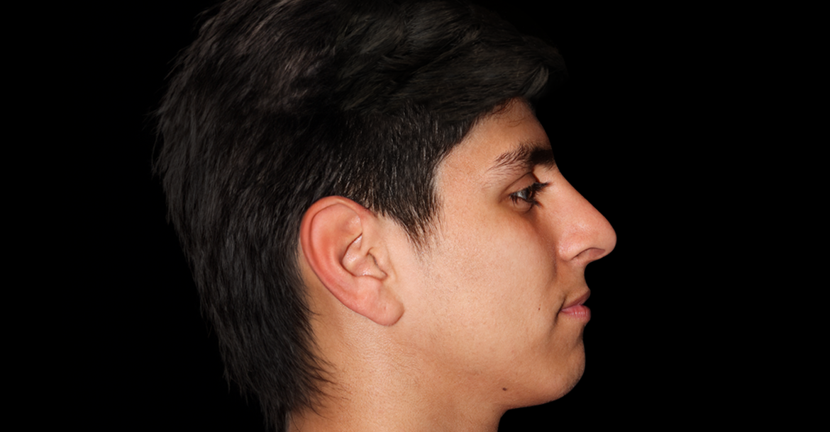 After-Rhinoplasty