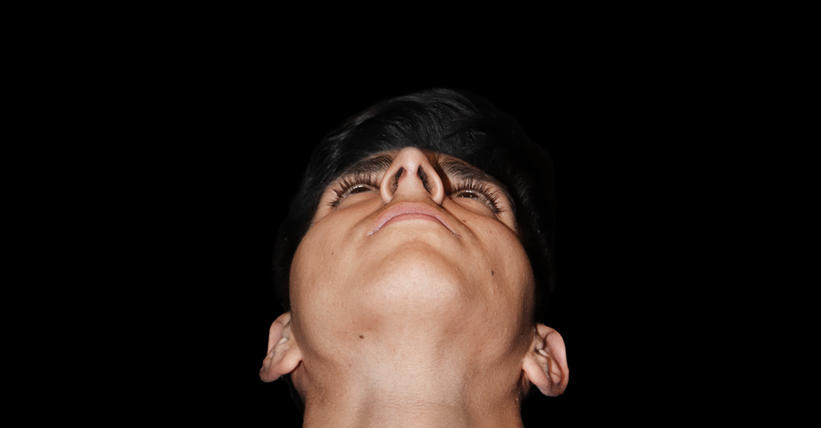 After-Rhinoplasty