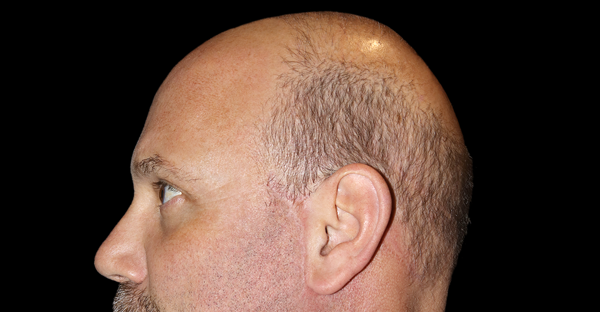 After-Upper Blepharoplasty