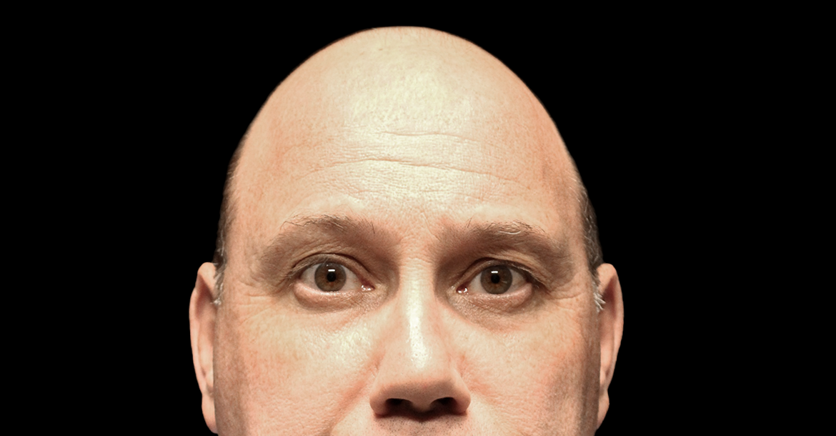 Before-Upper Blepharoplasty