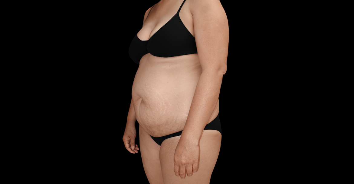 Before-Abdominoplasty