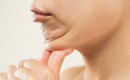 Chin Liposuction