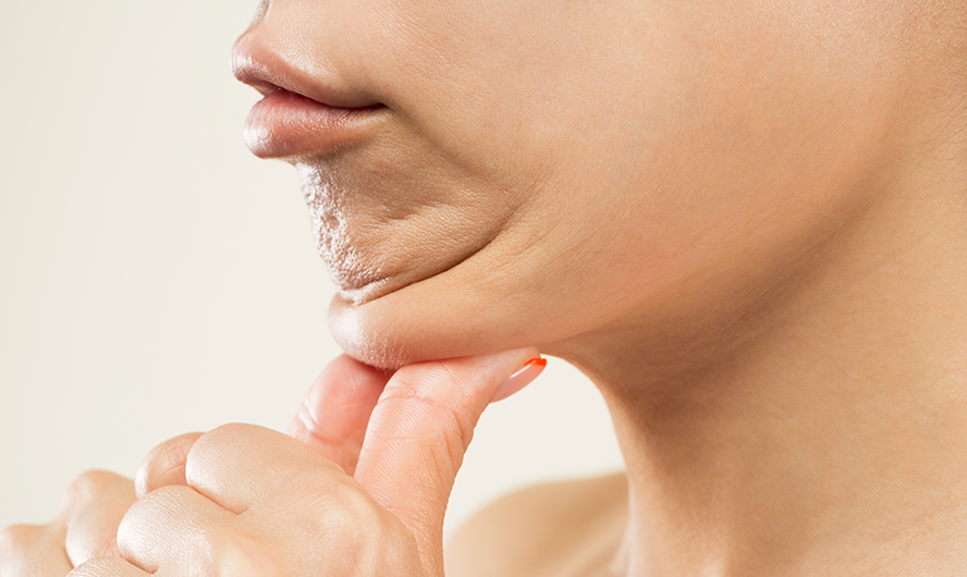 Chin Liposuction